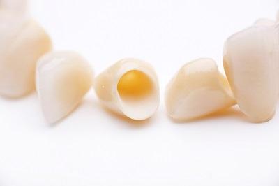 A picture of low-cost dental crowns at Smile Ninja Dental, a trusted family dentist in Fort Worth, Texas