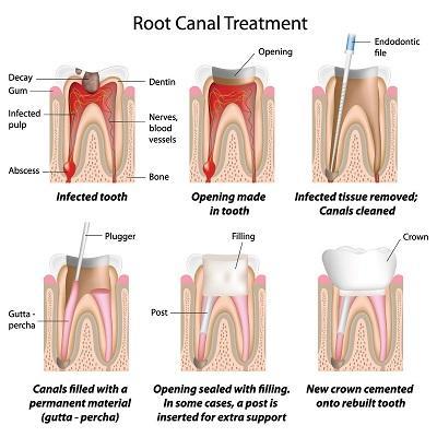 Diagram of cavities and root canals explaining the anatomy of a tooth and it's cavities